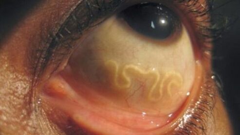a parasite in the human eye